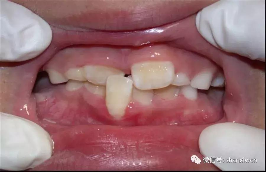 育儿知识关于牙齿,育儿知识幼儿牙齿敏感期