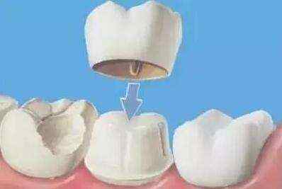 阿娇整牙,阿娇整牙前后对比