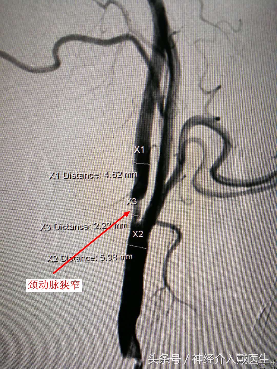 检查脑动脉硬化用什么仪器,脑血管检测仪器