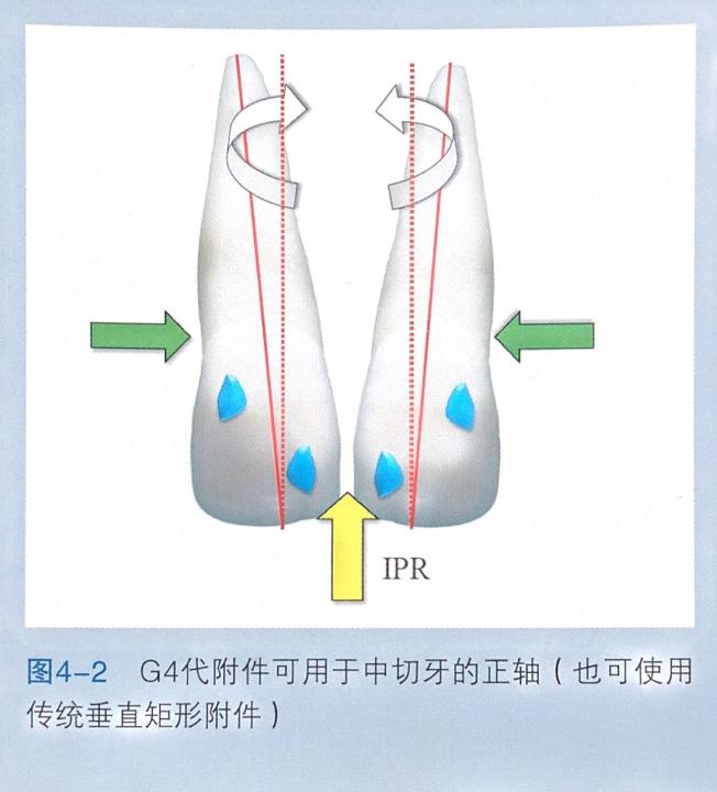 牙齿上的黑三角怎么去除,去除牙齿黑三角的神器