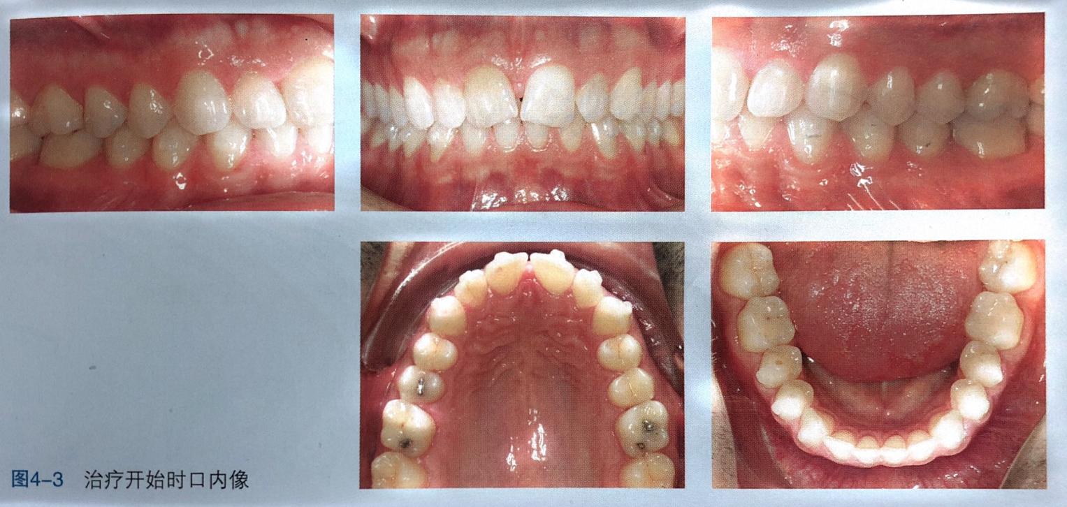 牙齿上的黑三角怎么回事,牙齿上的黑三角怎么改善