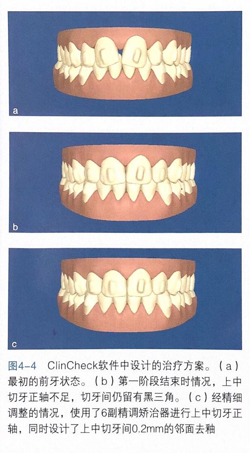 牙齿上的黑三角怎么去除,去除牙齿黑三角的神器