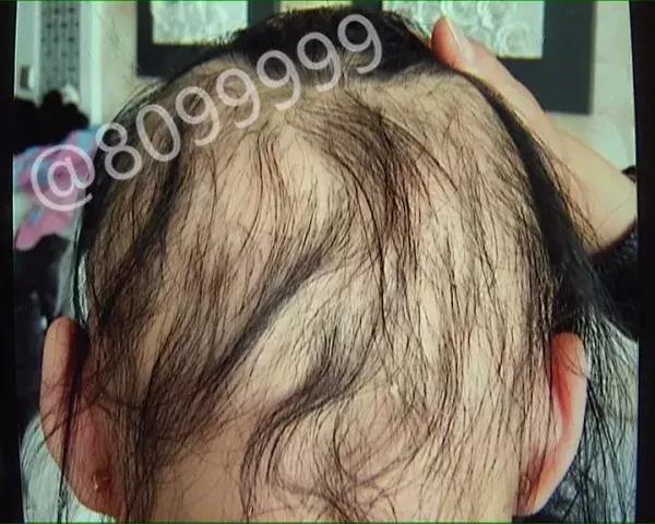 女子植发然后全部脱发,女子斑秃治疗后全秃