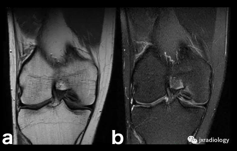 膝关节骨髓水肿疼痛特点,膝关节骨髓水肿的临床表现