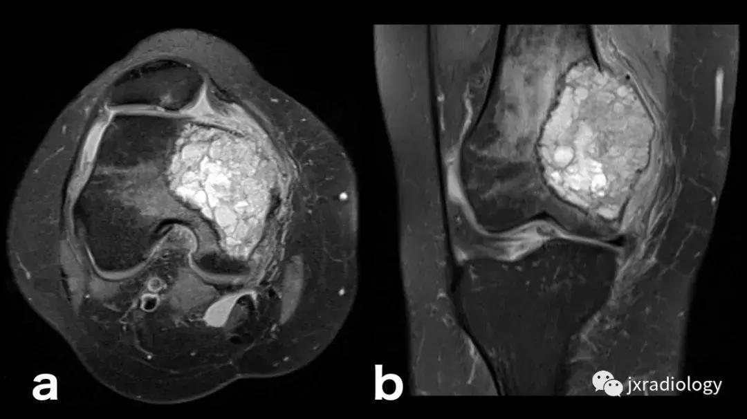膝关节骨髓水肿疼痛特点,膝关节骨髓水肿的临床表现