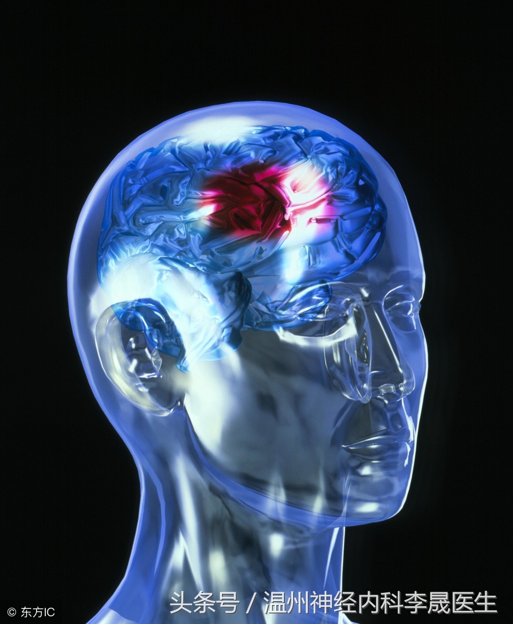 简述脑出血的内科治疗,脑出血中医解析