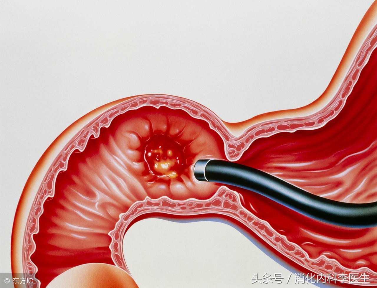胃溃疡和十二指肠溃疡的主要区别,胃溃疡跟十二指肠溃疡的疼痛区别