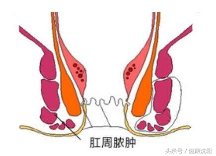 健康科普堂｜肛周脓肿和肛瘘的来龙去脉