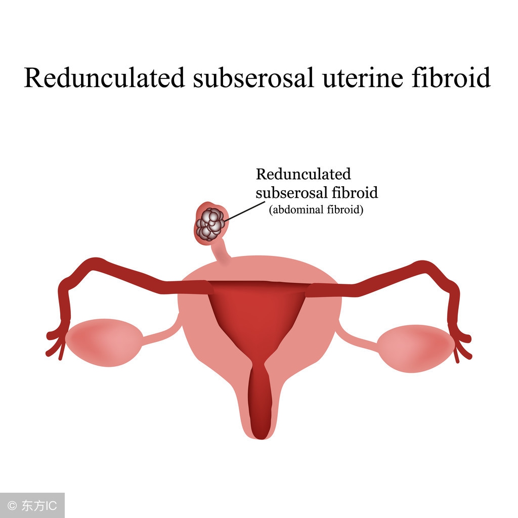 子宫肌瘤继发感染和变性哪个严重,子宫肌瘤继发变性有哪几种