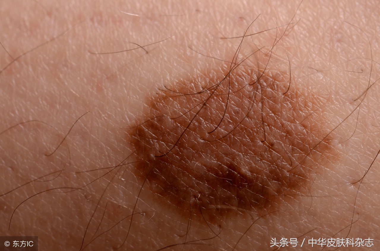 如何识别恶性痣,介于良性和恶性之间的结膜色素痣