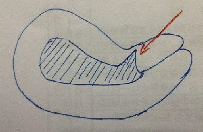 疤痕子宫可以生三胎剖宫产吗,一次剖宫产永远剖宫产吗