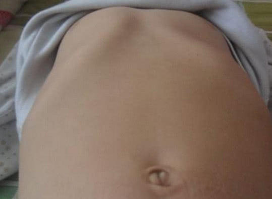 宝宝鸡胸能不能治好,孩子鸡胸是什么原因怎么办