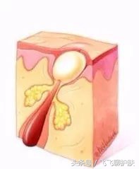 各种痘痘的类型及治疗方法,不同类型痘痘的症状及改善方法