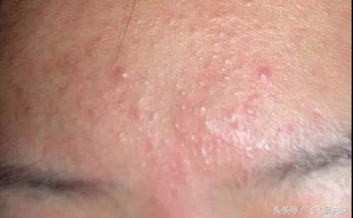 只有长痘才知道痘痘有多难治,要知道痘痘的根源
