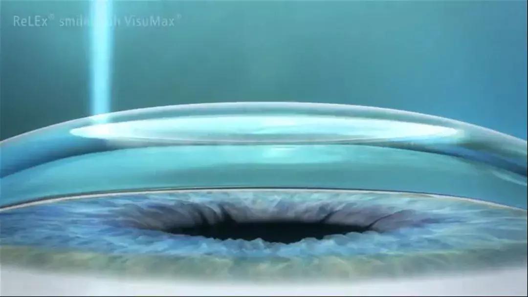 全飞秒和半飞秒治近视可重复做吗,全飞秒与半飞秒的治疗效果