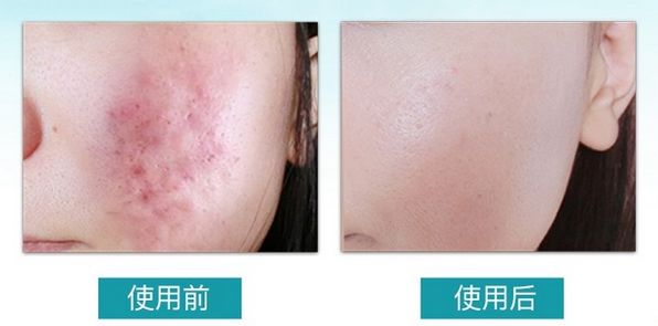 轻轻抹一抹皮肤越来越好,轻轻擦到皮肤就留下黑印子