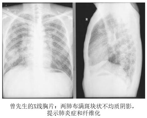 《癌症康复》每日谈｜氢分子与健康的故事（5）：氢气“护”肺