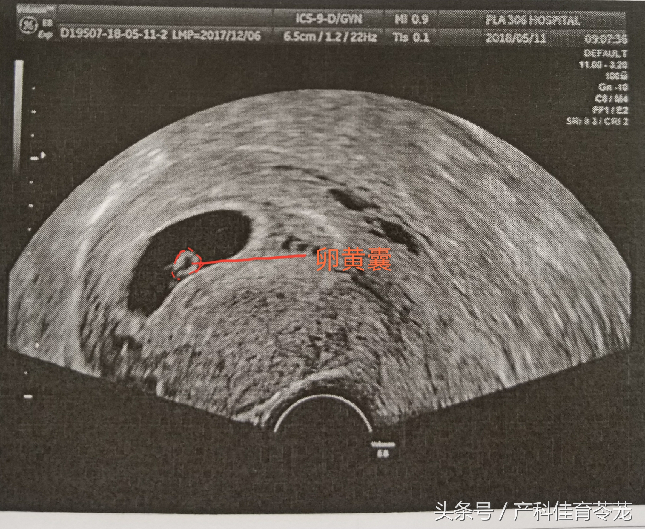 如何看懂乳腺超声检查报告,怎么能让临床医生看懂超声报告