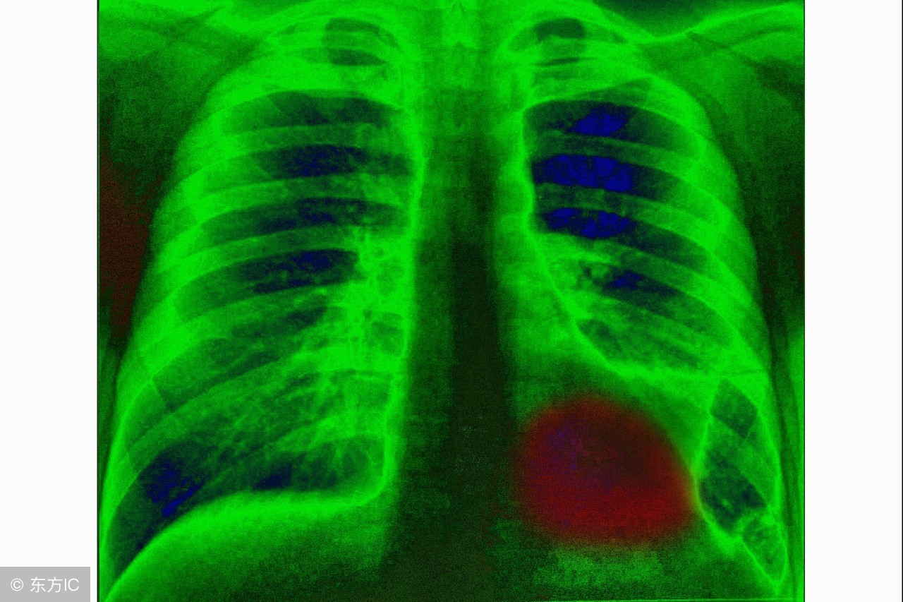 肺癌要知道的10件事,肺癌术后常见并发症和处理方法