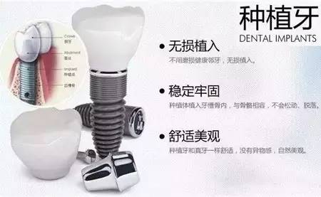 福州种植牙免费领取,福州种植牙降费纳入医保政策