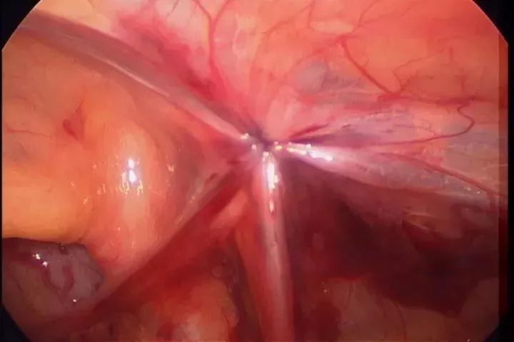 3d腹腔镜微创疝气修补术,成人疝气腹腔镜微创