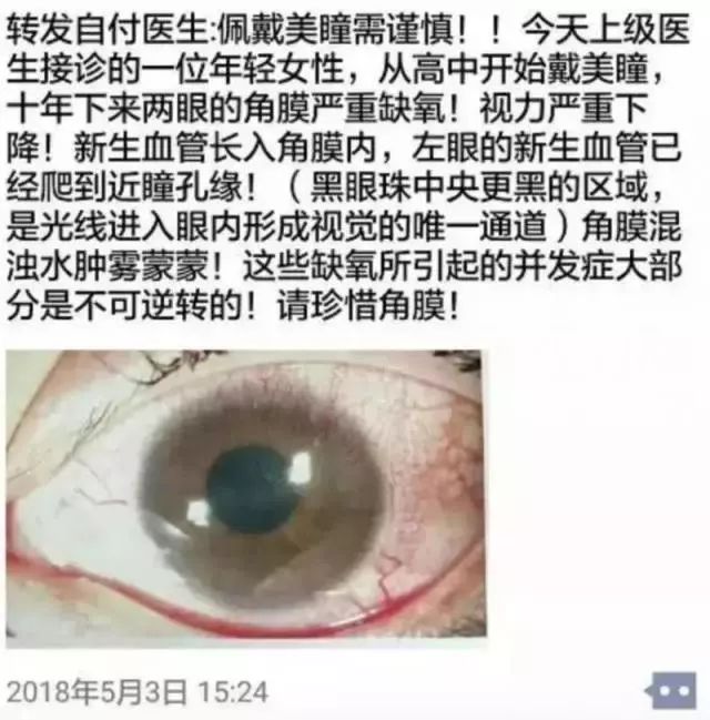 美瞳真的有这么可怕吗 (美瞳能毁掉双眼吗)