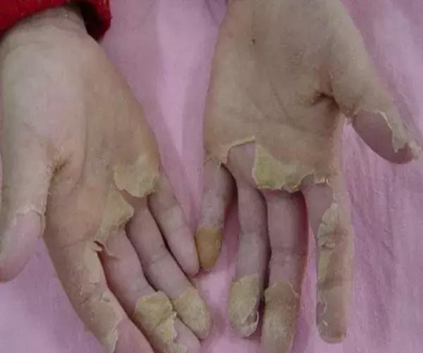 夏季猩红热高发家有娃娃要当心,为什么猩红热高发于儿童