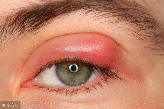 轻视小儿麦粒肿带来终生伤害,小小麦粒肿