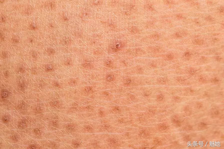 鸡皮肤脂肪痘怎么解决,儿童鸡皮肤怎么护肤