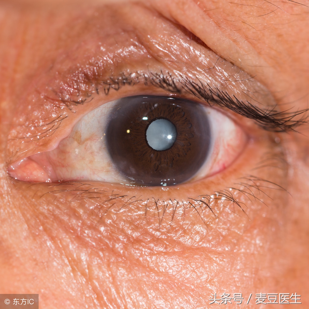 糖尿病引发的白内障最佳治疗方法,糖尿病人患有轻微白内障怎么治疗