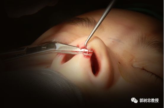 鼻整形话术,鼻整形沟通