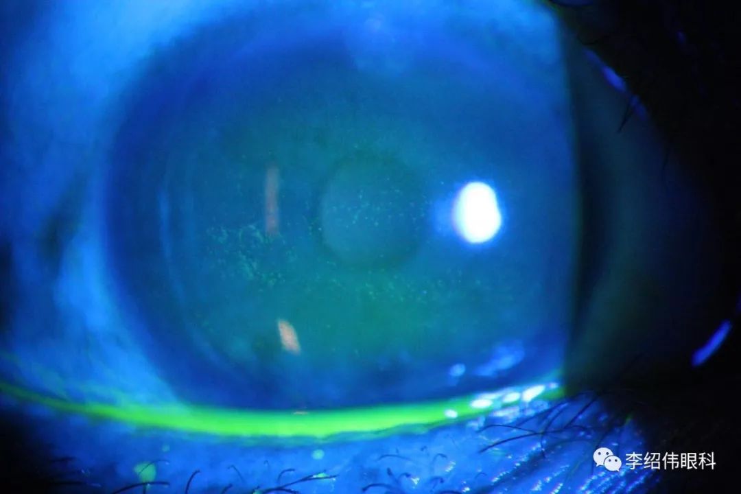 李绍伟爱尔眼科手术案例,李绍伟爱尔眼科