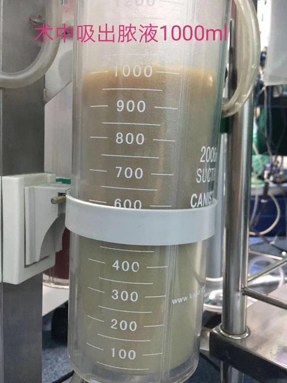 盆腔炎小便疼痛是怎么回事,盆腔炎老是想大便怎么回事