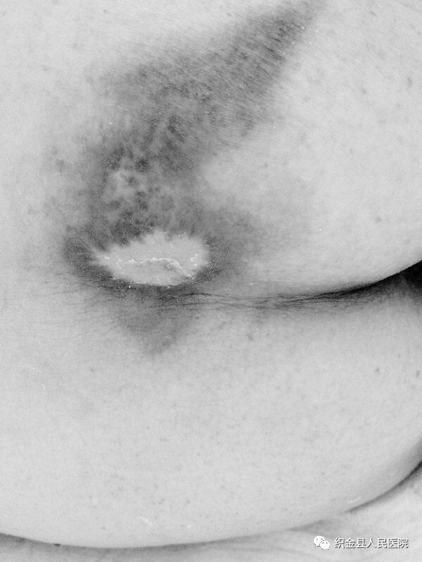 医患情深2019,伤口造口护理医患对话