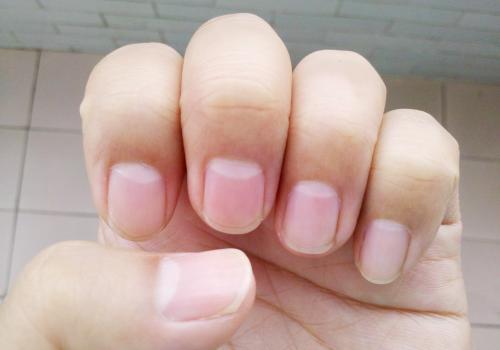 半月痕越来越小,半月痕消失了严重吗