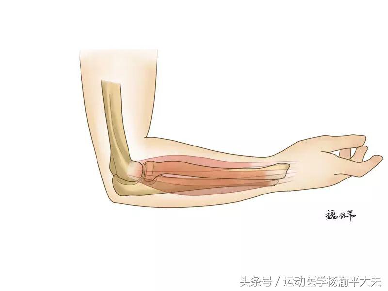 顽固性网球肘治疗,打网球的想法