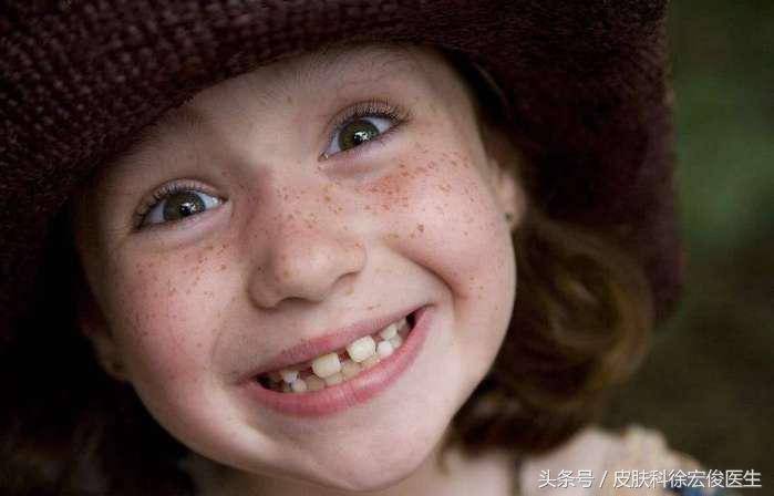 雀斑能靠药物祛除吗,雀斑靠吃药抹药调理就可以消除吗