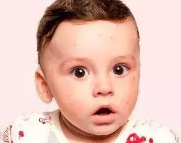 幼儿急疹猩红热水痘手足口鉴别,麻疹猩红热水痘手足口鉴别