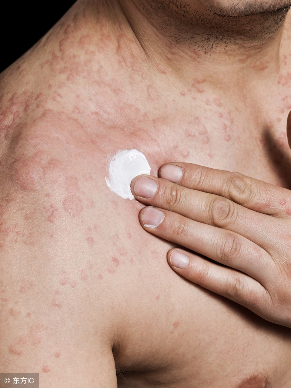 湿疹病程的几个阶段,慢性皮炎湿疹的典型症状表现