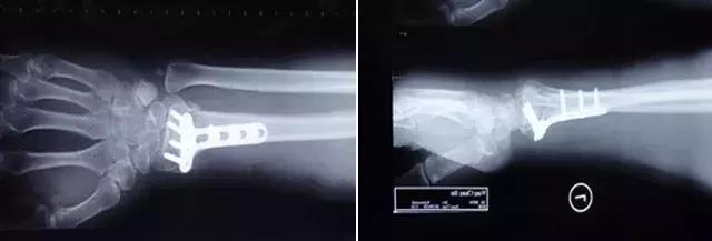 医生说骨头愈合很好,医生说恢复很好骨头没长