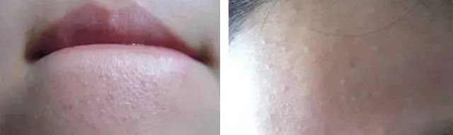 长闭口的正确消除方法,长闭口的正确消除方法新手入门