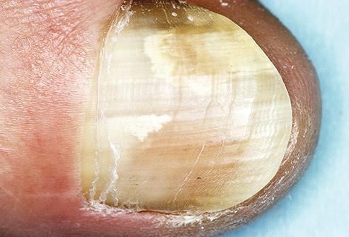 脚趾甲发绿图片,如何判断脚趾甲变色