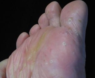 脚气特别痒用什么药能根治,脚气真菌感染怎么越治越厉害