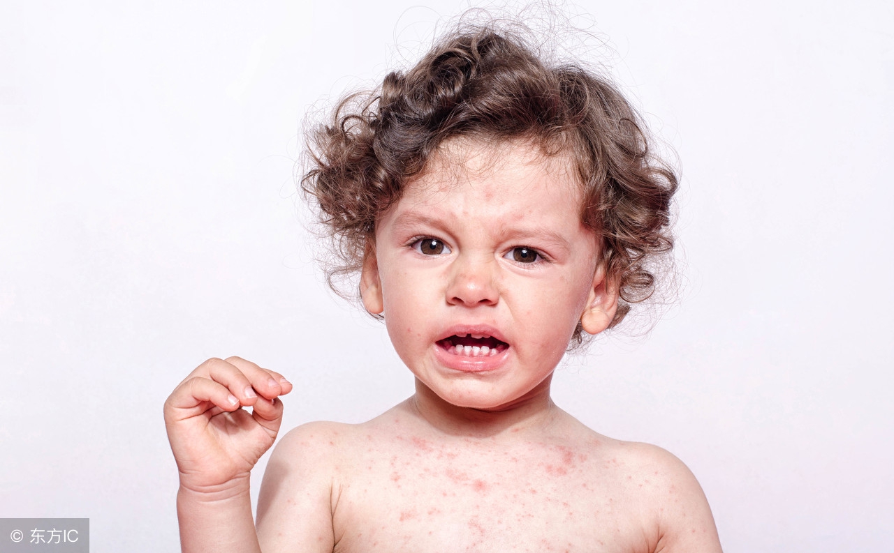 *麻疹荨**：拔罐还可以治疗*麻疹荨***麻疹荨**有哪些饮食禁忌？