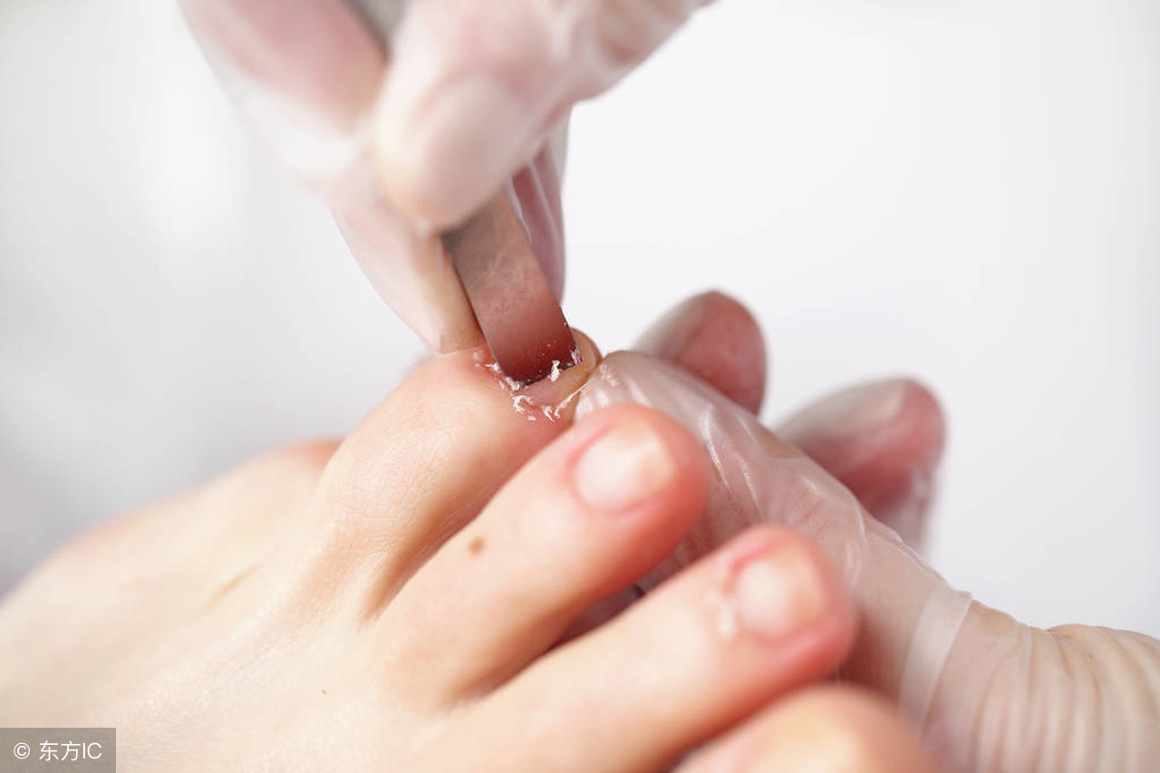 手足癣的传播途径是啥？有啥危害表现