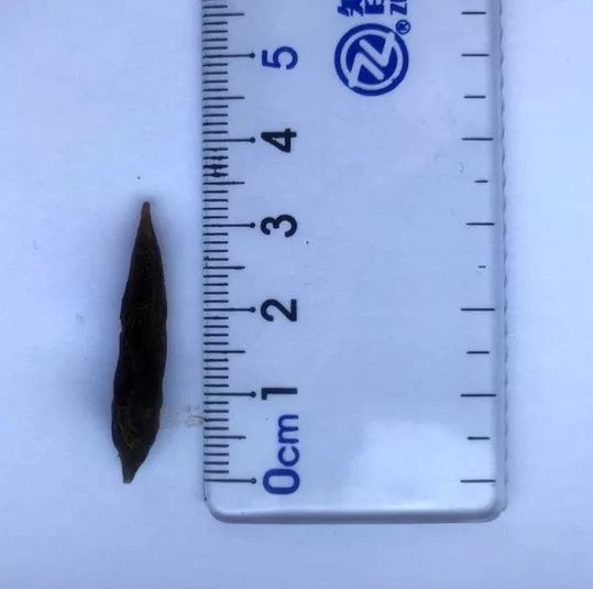 误吞了枣核怎么处理,医生误吞枣核处理方法