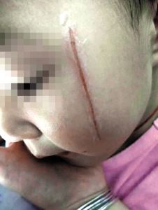 孩子脸被同学划破家长怎么处理,4岁女童脸被划破后续