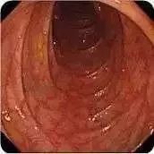 便秘严重喝的茶,一种很苦的茶改善便秘