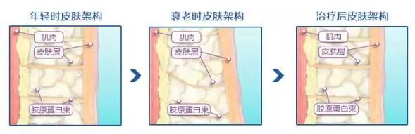 如何解决掉显老又讨厌的法令纹,法令纹不用愁一招帮你改善