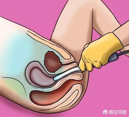 试纸测试怀孕了但是阴超看不到,尿试纸测怀孕是否可以说明着床